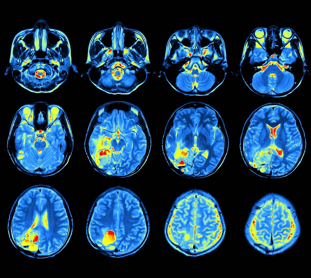 scan of blue and green human brain patterns above black backdrop